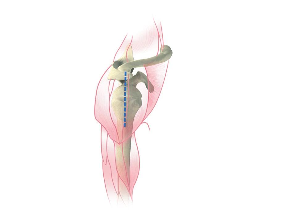 The upper portion of the pectoralis may be released in order to improve external rotation. The clavipectoral fascia is incised along the lateral border of the conjoined tendon.