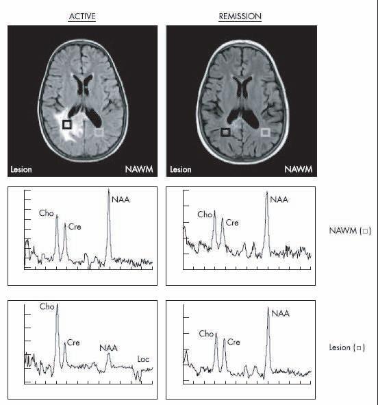 Neuroimaging in a juvenile CNS-SLE patient Figure 2.