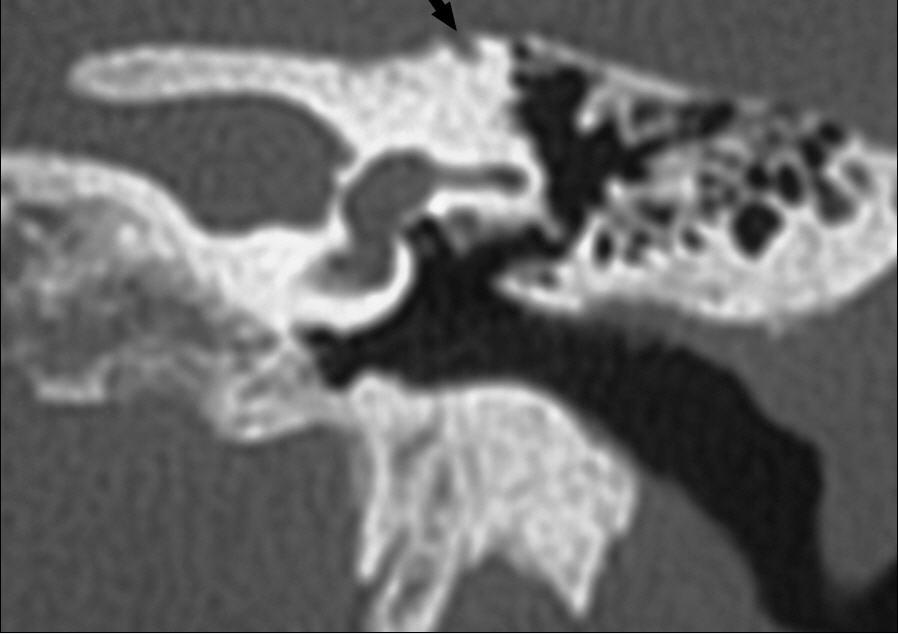 Figure 2. Coronal CT scan right ear.