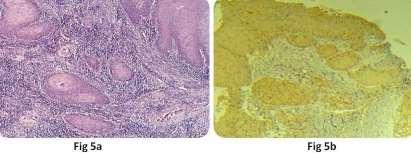 Fig-6: (a) H & E Staining (10x) of Severe dysplasia; (b) Expression of Metallothionein in Severe dysplasia Fig-7: (a) H & E Staining