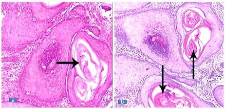 Fig.1 Keratin pearl staining in oral squamous cell carcinoma by H&E (a) and Modified Papanicolaou (b) stain. Fig.