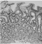 ? Resolution not established Superficial Gastritis Hypo-secretory Hyper-secretory Chronic Pangastritis Antral Chronic Atrophic Lymphocytic