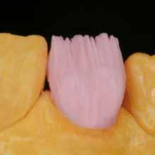 INDIVIDUAL LINE Build-up Building-up the complete anatomical tooth shape in Dentin. Fig.