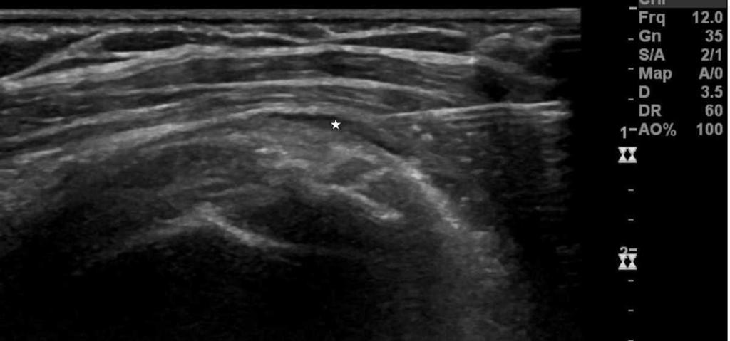 Fig. 1: After identification of the calcification(s) with a 12 MHz probe the needle was directed towards the calcification(s) in the supraspinatus tendon. Fig.