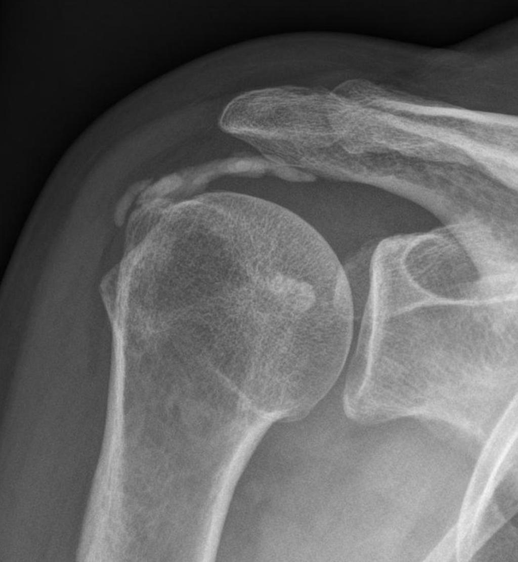 Fig. 5: Anteroposterior radiograph of the right shoulder of a 60-year-old woman who had calcific tendinitis for