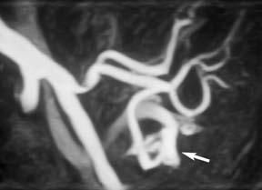 Imge shows dilttion of the left gstric vein (rrows) s n indirect sign of portl hypertension.