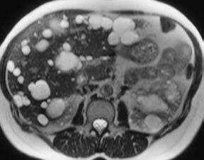 12 1TheLiver Fig. 1.9, Multiple liver cysts in ptient with utosoml dominnt polycystic kidney disese (1.5 T). Single-shot T2w TSE imge. T1w GRE imge. Both imges were cquired during reth-hold.