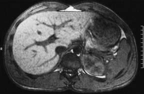90 4TheSpleen Fig. 4.3 c Splenic lesion in 28-yer-old mn on chemotherpy for Hodgkin disese. Unenhnced nd dynmic postcontrst imges otined immeditely nd 5 min fter injection of Gd-sed contrst medium (0.