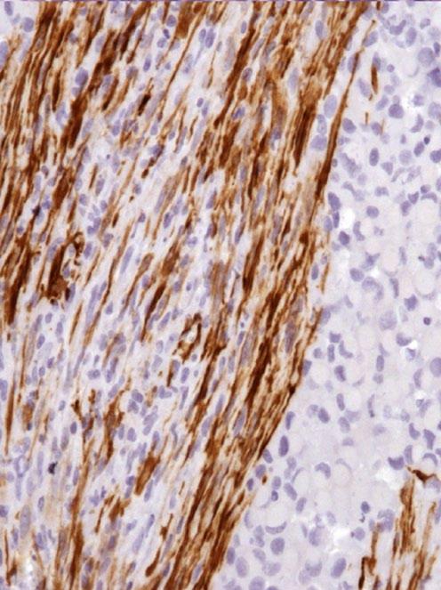 Signet-ring cell melanoma and myofibroblastic differentiation 433 Table 2. Antibodies and immunohistochemical staining results.* Primary antibody Immunohistochemical staining Figure 4.