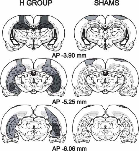 Minimal damage in the dorsal subiculum was observed in only one subject. Damage to the parahippocampal cortical areas was not observed.