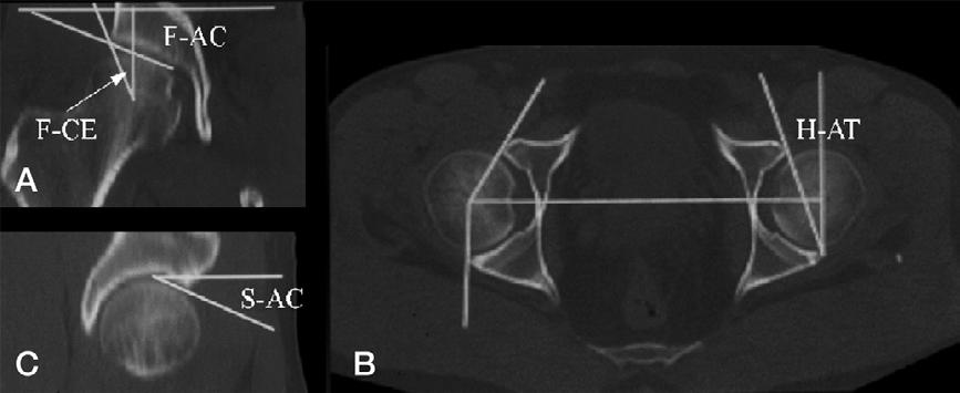 304 Acta Orthopaedica 2005; 76 (3): 303 313 Figure 1. Reformatted CT slices: A) frontal view, B) horizontal view, and C) sagittal view.