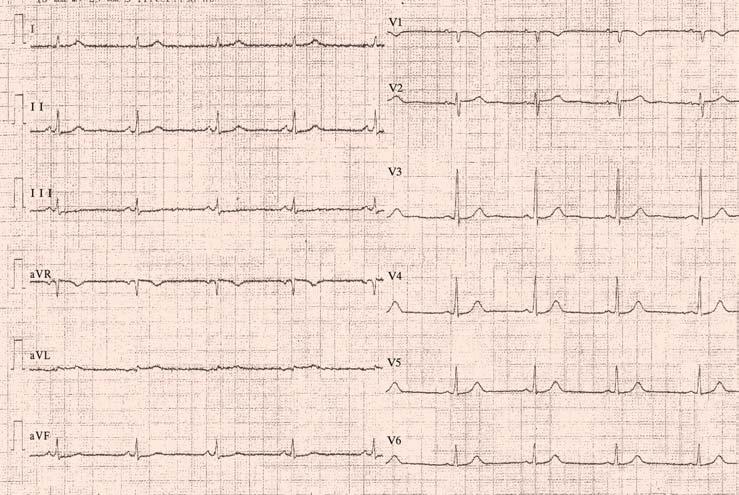 Short-Coupled Torsade de Pointes did not report any family history of syncope, or premature or sudden death.