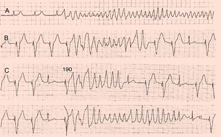 bradycardia or pauses. Short-coupled ventricular extrasystoles do not correspond to the timing of U waves on the surface ECG.