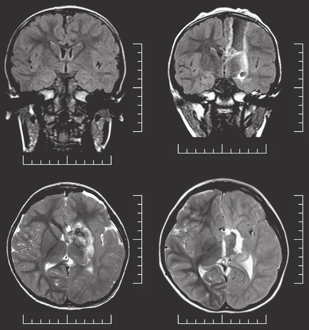 R. Vydrova, et al. A B C D Figure 2. Brain MRI of the patient. (A) Presurgical coronal FLAIR sequence consistent with a diagnosis of left hemispheric cortical dysplasia.