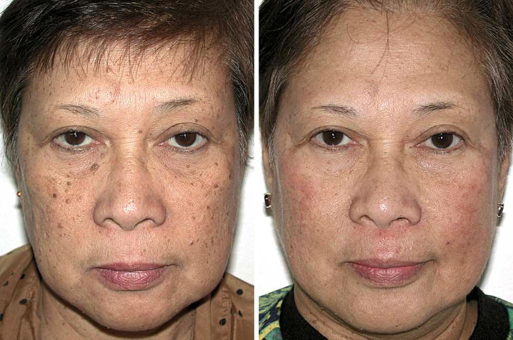 lasers. Note the overall improvement in erythema, pigmentation, skin tone and texture, pore tightening, and fine wrinkles.