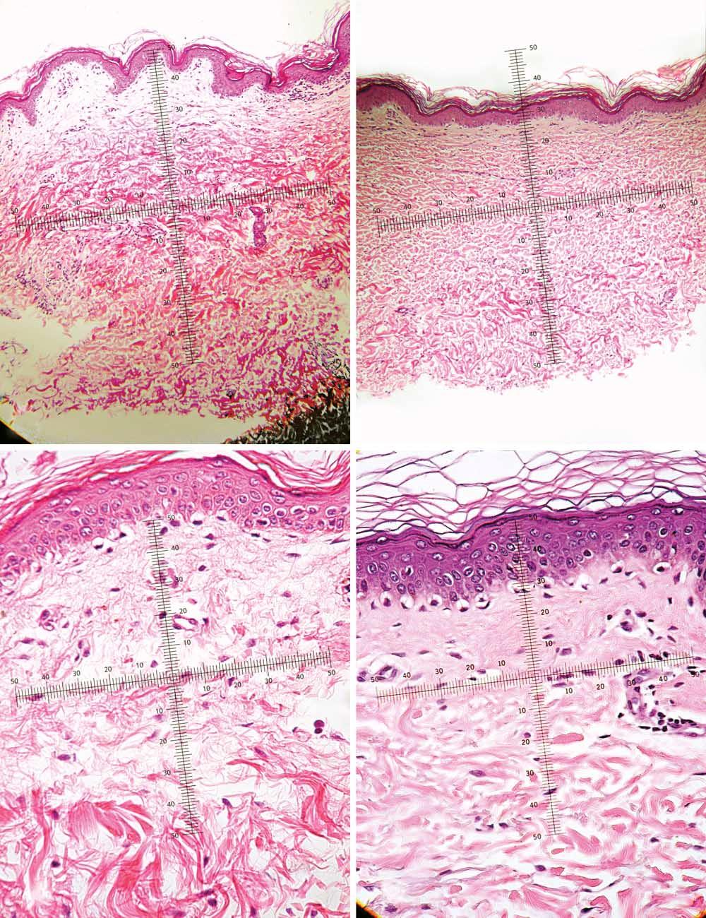 A C D Figure 7. iopsy specimens of inner arm skin of a 51-year-old woman before (A) and 6 months after () 6 treatments with combined potassium titanyl phosphate (KTP) and Nd:YAG lasers.