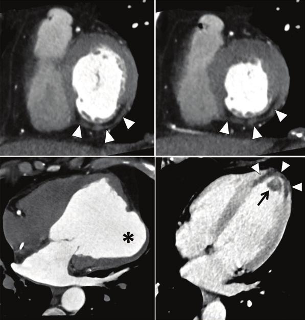 132 Cademartiri et al. CT myocardial perfusion imaging A Dia Sys B C Figure 2 CT rest perfusion imaging of myocardial infarction.