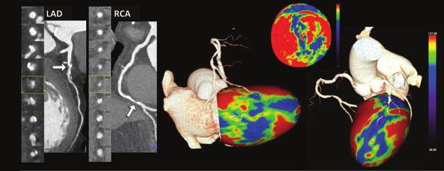 134 Cademartiri et al. CT myocardial perfusion imaging A B Figure 3 Static monoenergetic CT myocardial perfusion imaging. A 77-year-old male patient presented with atypical chest pain.