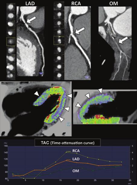 136 Cademartiri et al. CT myocardial perfusion imaging A B C Figure 5 Dynamic CT myocardial perfusion imaging.