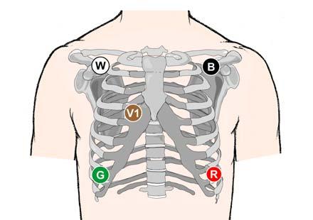 78 Chapter 5: An ECG Primer In addition, the multiple view monitor can provide a more balanced electrical representation of both the right and left sides of the heart.