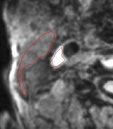 Methods Brain and carotid imaging DTI, FLAIR, DWI, fmri Time of Flight MRA ± CE-MRA MRI carotid wall imaging Coronal T 1