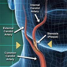 Treatment Considerations for Carotid Artery Stenosis