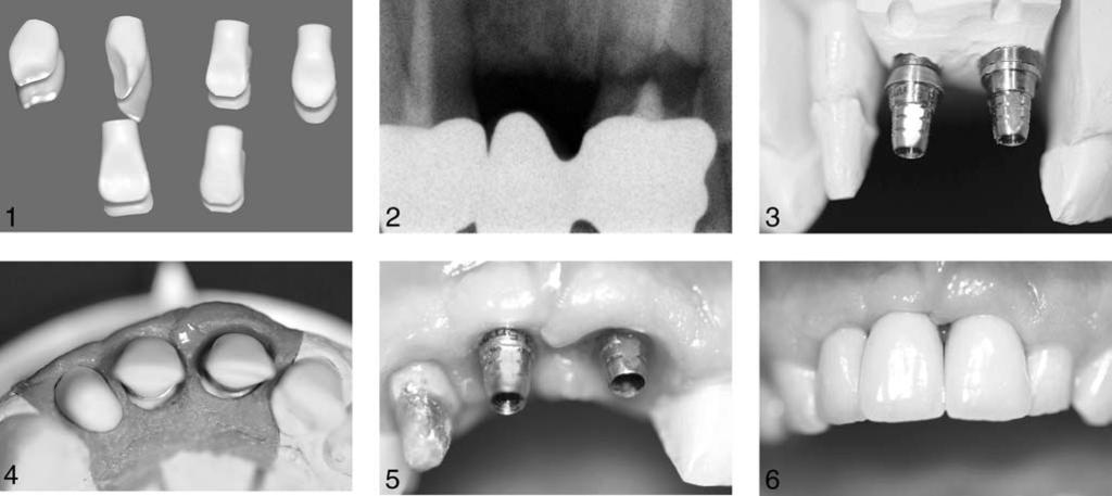 SINGLE-TOOTH IMPLANT RESTORATIONS FIGURES 1 6. FIGURE 1. Six ceramic copings are shaped like prepared natural teeth. FIGURE 2. Case 1.