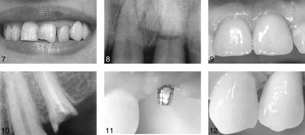 Guido Schiroli FIGURES 7 12. FIGURE 7. Case 2. Patient presented with a fractured left-central incisor from a motorbike accident. FIGURE 8. Case 2. Periapical radiographic revealed a maxillary right-central incisor root defect.