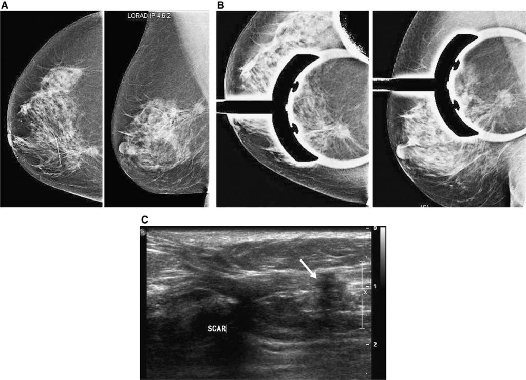 Pitfalls in mammographic interpretation / Canadian Association of Radiologists Journal 62 (2011) 50e59 59 Figure 11.