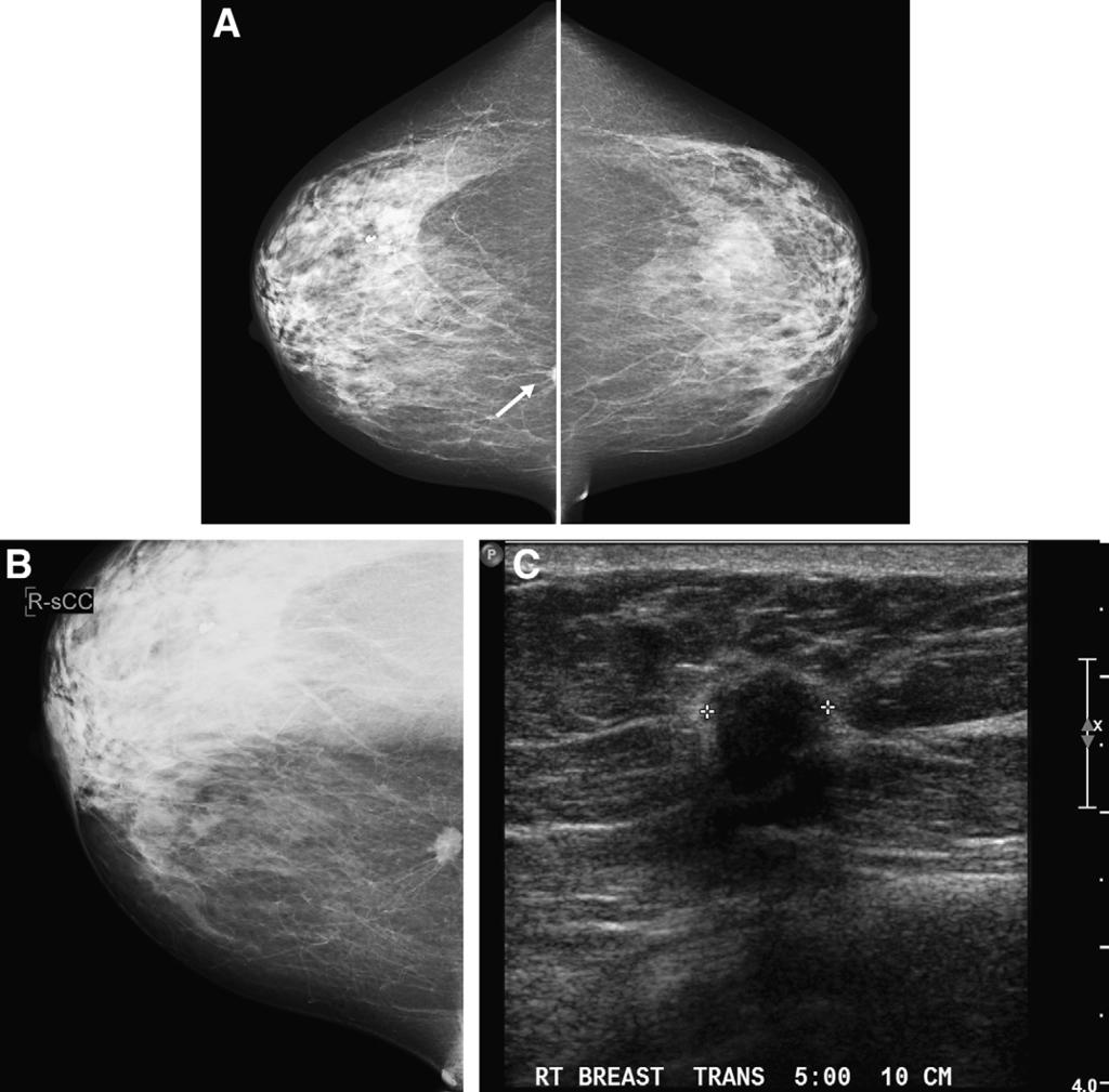 Pitfalls in mammographic interpretation / Canadian Association of Radiologists Journal 62 (2011) 50e59 51 Figure 1. Screening mammogram in a 60-year-old woman who is postmenopausal.