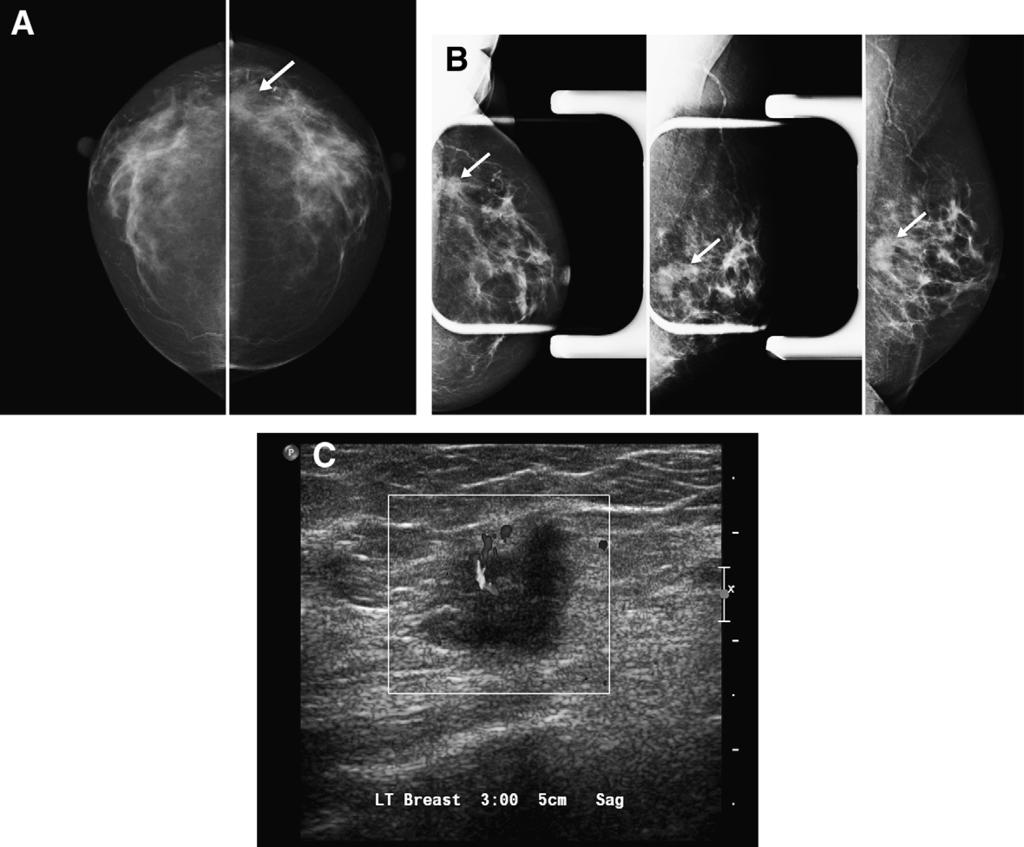 52 S. Roberts-Klein et al. / Canadian Association of Radiologists Journal 62 (2011) 50e59 Figure 2. Screening mammogram in a 72-year-old woman.