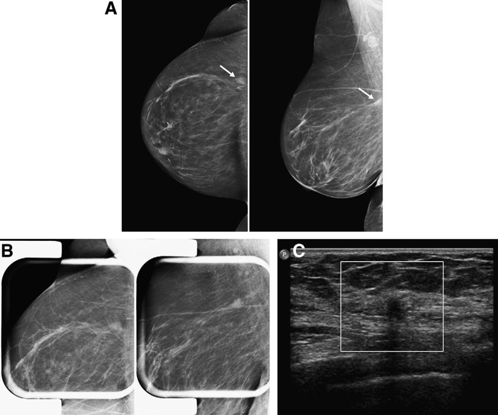 Pitfalls in mammographic interpretation / Canadian Association of Radiologists Journal 62 (2011) 50e59 53 Figure 3. An 80-year-old woman for screening.