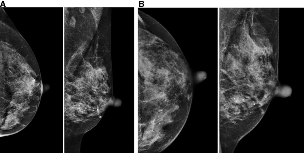 interpreting radiologist. (B) Spot compression images demonstrating the mass to better advantage.