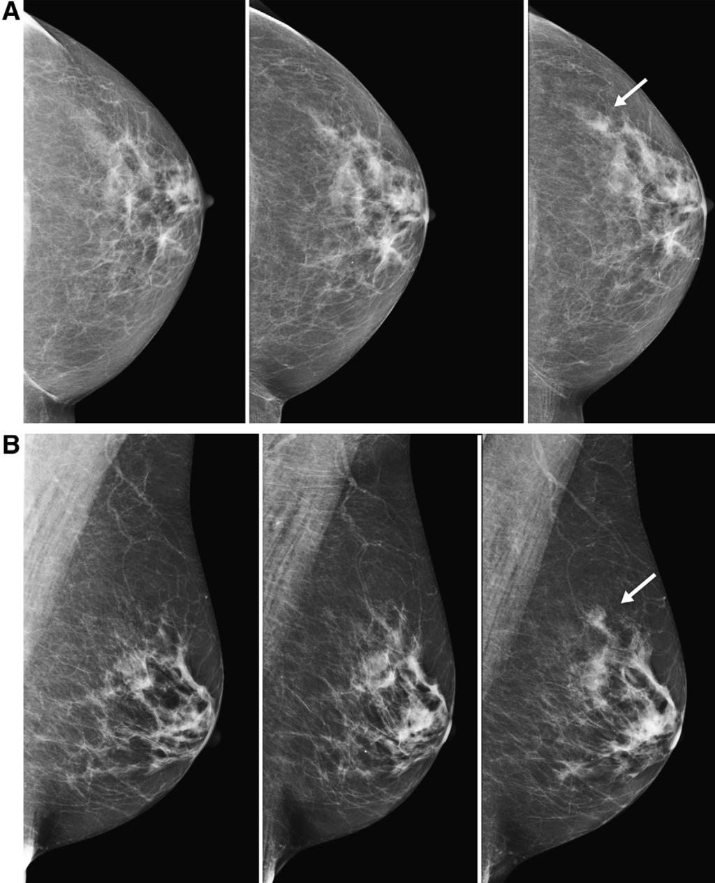 54 S. Roberts-Klein et al. / Canadian Association of Radiologists Journal 62 (2011) 50e59 Figure 5. A 67-year-old woman for screening.