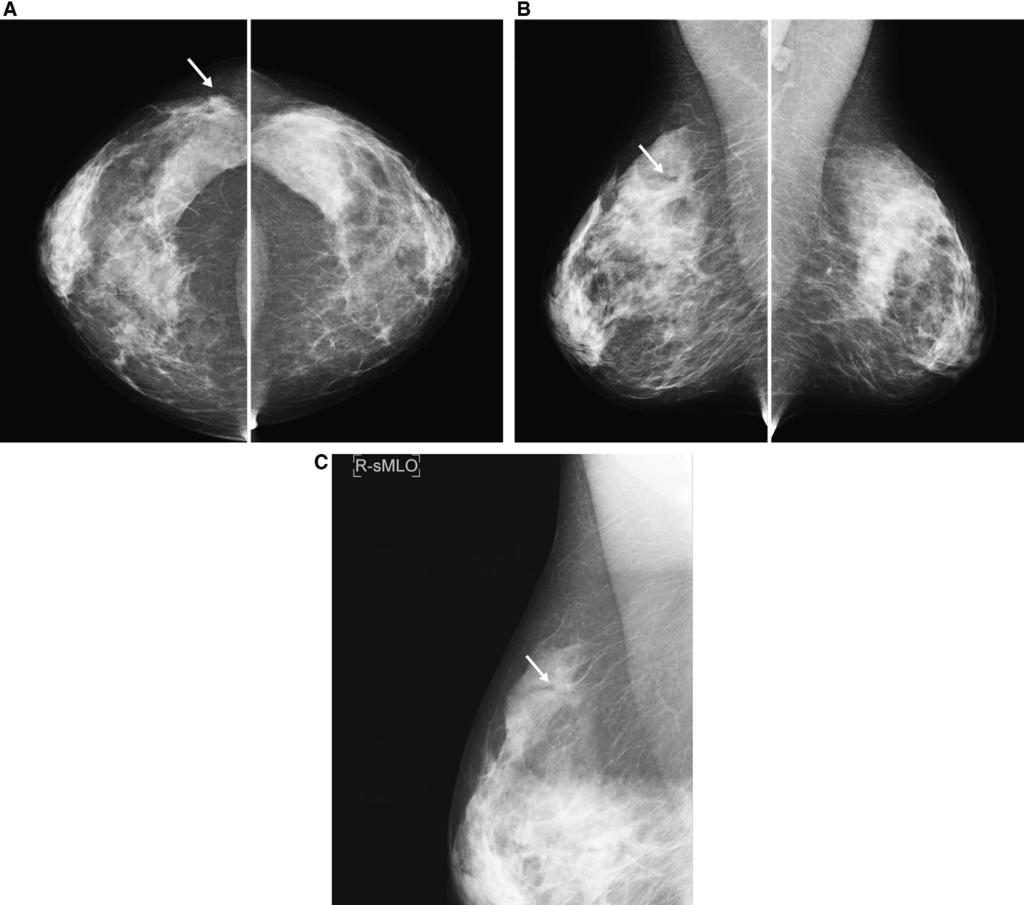 Pitfalls in mammographic interpretation / Canadian Association of Radiologists Journal 62 (2011) 50e59 55 Figure 6. A 61-year-old woman for screening.