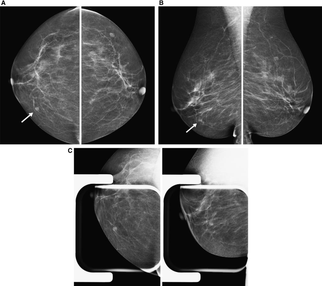 Pitfalls in mammographic interpretation / Canadian Association of Radiologists Journal 62 (2011) 50e59 57 Figure 8. A 60-year-old woman for screening.