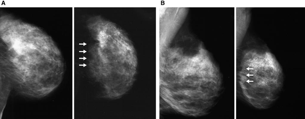 (A) Craniocaudal and (B) mediolateral oblique views from diagnostic mammogram, showing a nodule along the central outer right breast (arrow).