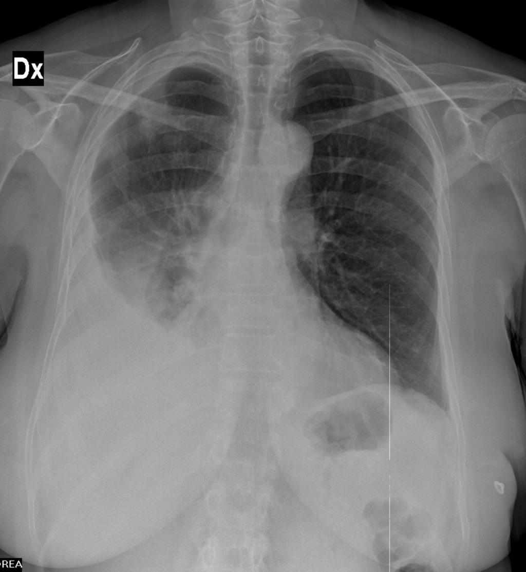 Fig. 8: X ray chest radiography
