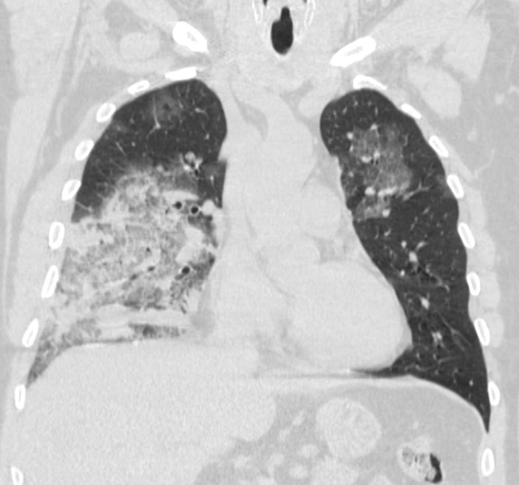 Fig. 1: Coronal CT scan shows bilateral pneumonia with
