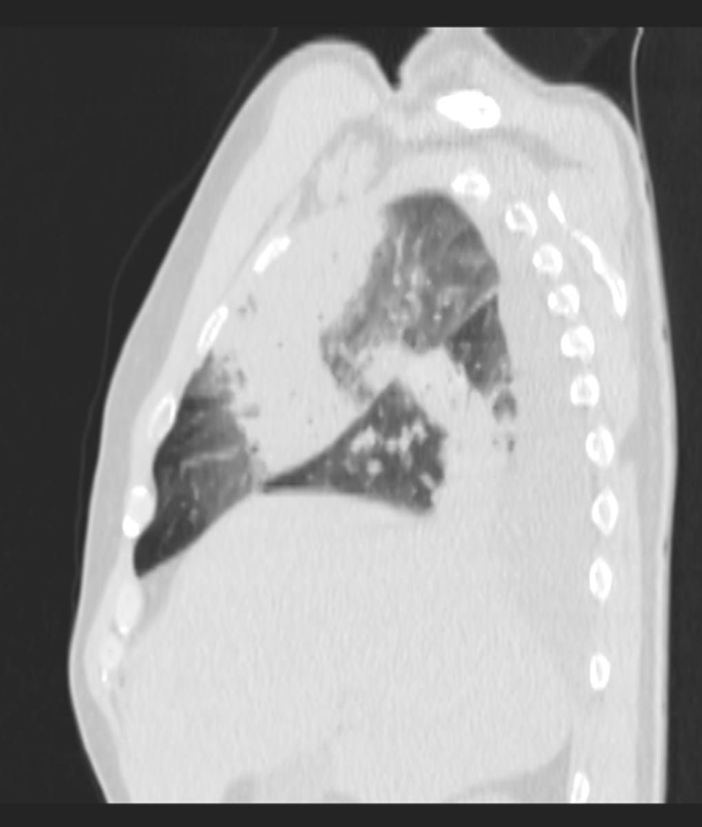 Fig. 2: Sagittal CT scan shows typical segmental