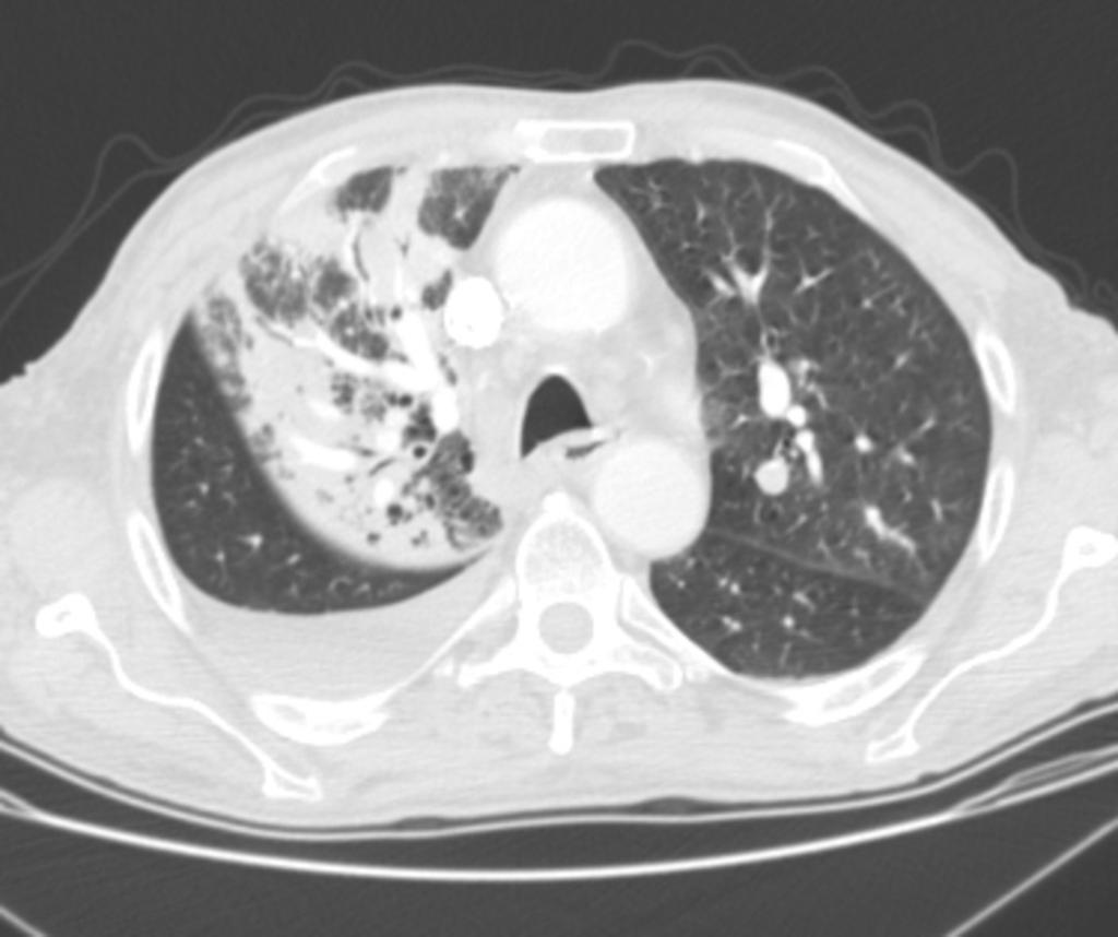 Fig. 4: CT scan displays typical non segmental