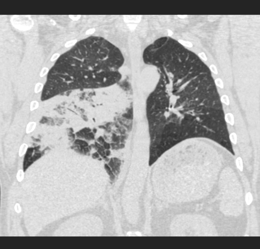 Fig. 5: Coronal CT scan displays