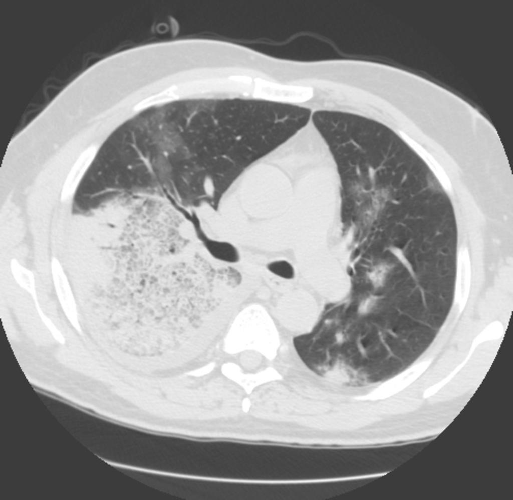 Fig. 6: Axial CT scan shows a bilateral pneumonia with typical non segmental distribution in right lower lobe