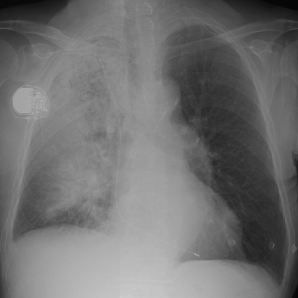 Fig. 7: X ray chest radiography shows multiple