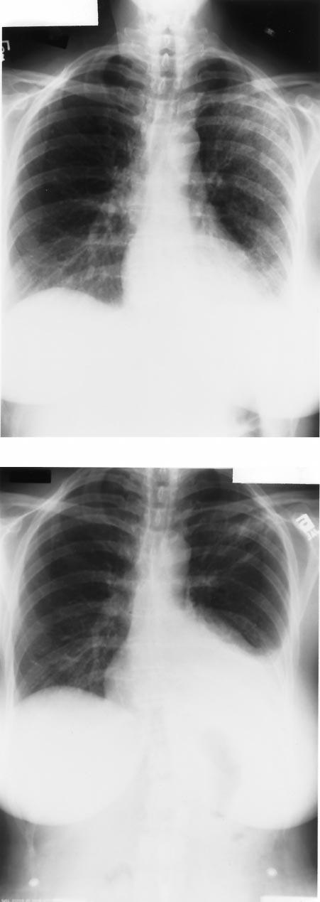 chest radiographic findings continued to worsen between days 2 and 6 in the form of increasing consolidation of the same lobe, involvement of a contiguous lobe or ipsilateral noncontiguous lobe,