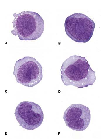 Abnormal monocytes A, B