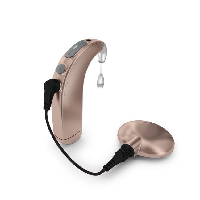 Cochlear implants One technological development that helps individuals with severe to profound