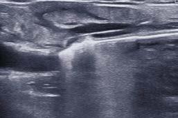 The fl exible applicator is passed under ultrasound monitoring into the aff ected vein.