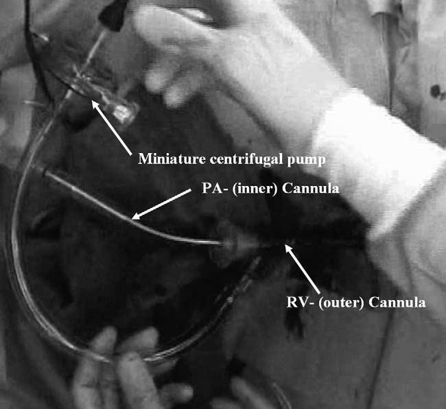 The tip of the inner tube was positioned in the main pulmonary artery. Transesophageal echocardiography was used to monitor the procedure and guide positioning of the cannulas (Fig 2). The Fig 3.