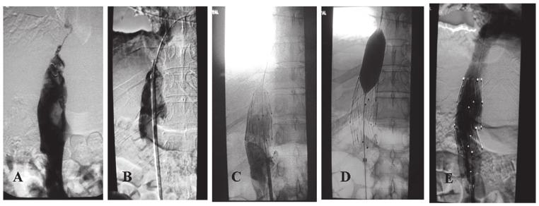 1256 Figure 2. Type I inferior vena cava (IVC) limited stenosis combined with IVC partial block-like thrombosis. (A) There was residual mural thrombus on the IVC wall.